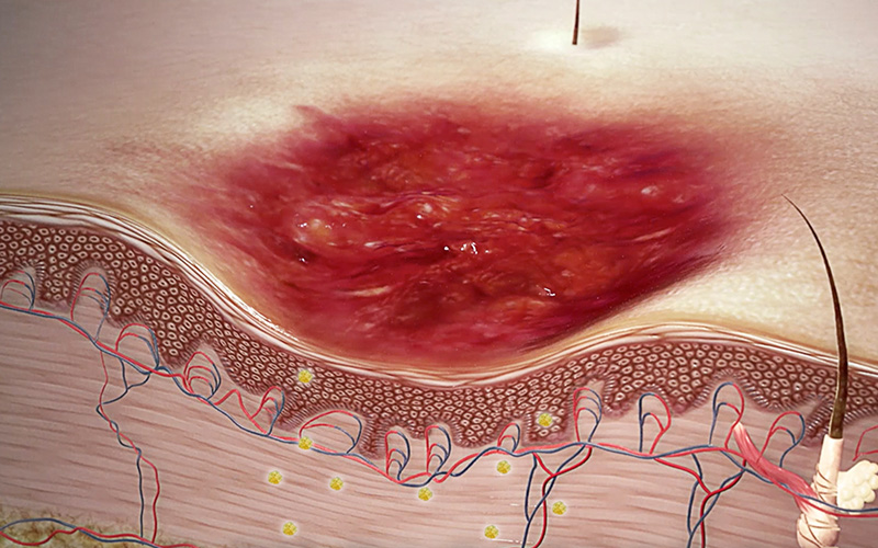This video shows how Cutimed Epiona supports and facilitates the healing of chronic and stagnating wounds and can be used for superficial and deep wounds.  This video shows how Cutimed Epiona supports and facilitates the healing of chronic and stagnating wounds and can be used for superficial and deep wounds.